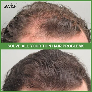 Sevich צמיחת השיער ספריי 120ml נגד נשירת שיער טיפול קרם טבעי צמיחת השיער ספריי סרום שיער הקרקפת טיפולים המוצר - התמונה 2  